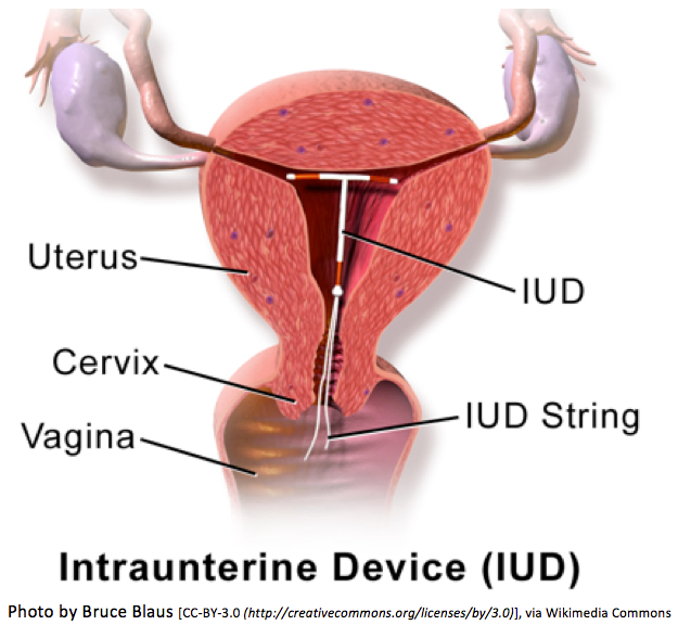 iud